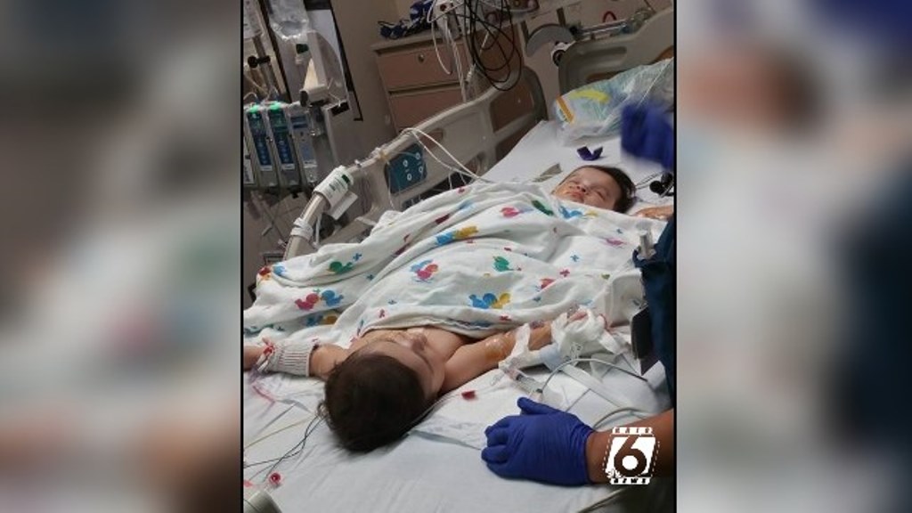 Separan a hermanitas siamesas en Texas