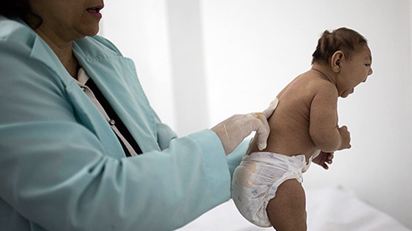 Confirman primer nacimiento de bebé con microcefalia por Zika en EUA