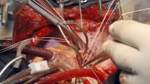 Colocan primer implante de corazón artificial a niña de 4 años en México