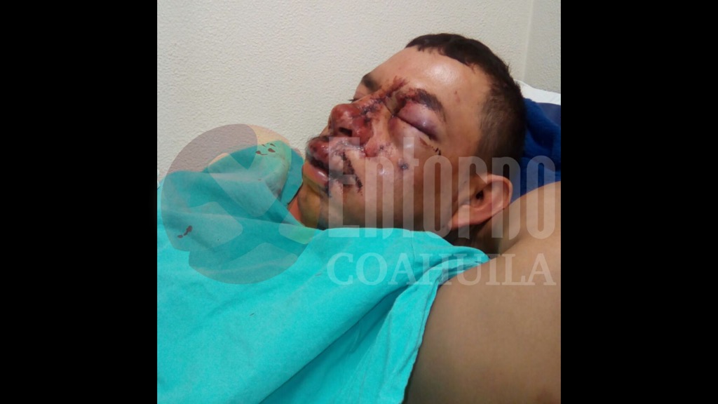Le desfiguran el rostro en riña a maderense