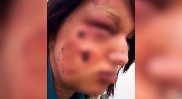 Por ataque de celos mujer ataca a mordidas a su presunta rival