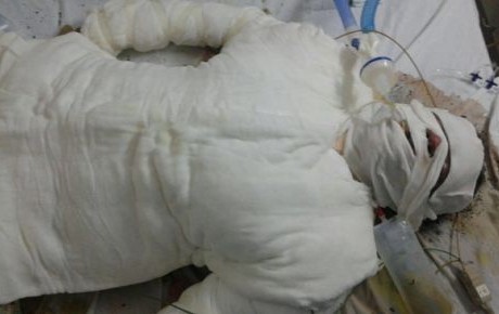 Muere mujer en Oaxaca tras ser quemada con gasolina por su marido