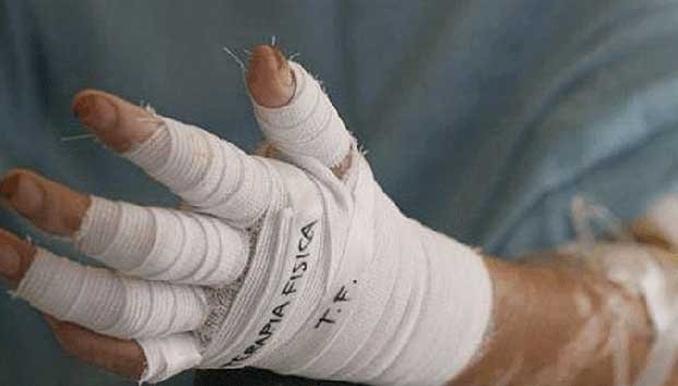 Hermanos queman a niña de 12 años