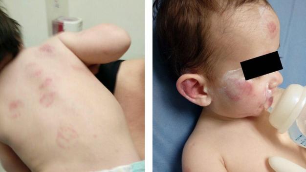 Cierran guardería en San Nicolás por 25 mordidas a bebé