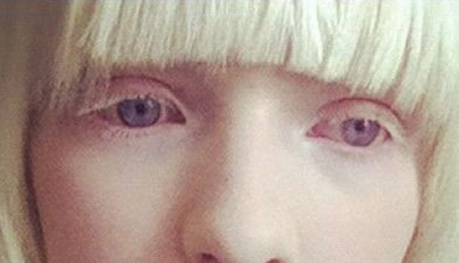 Hoy, Día Internacional de la Sensibilización sobre el Albinismo