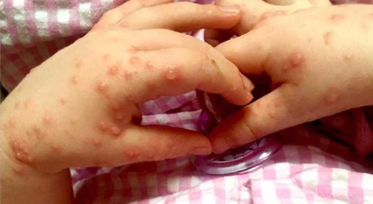 Alertan médicos por el virus boca-pie-mano