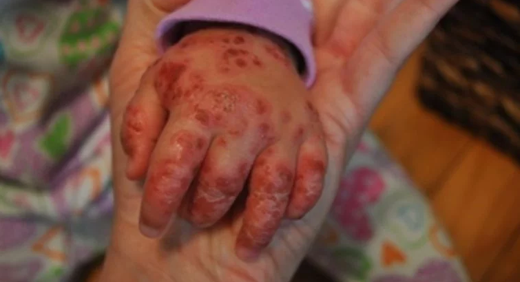 Lavado de manos, mejor tratamiento contra el coxsackie