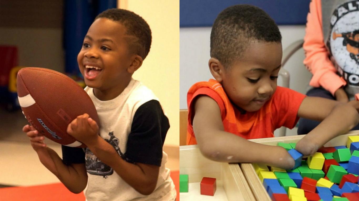 Trasplante de manos a niños es un exito