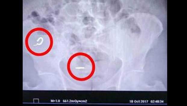 Ladrón termina en hospital por tragarse aretes de oro