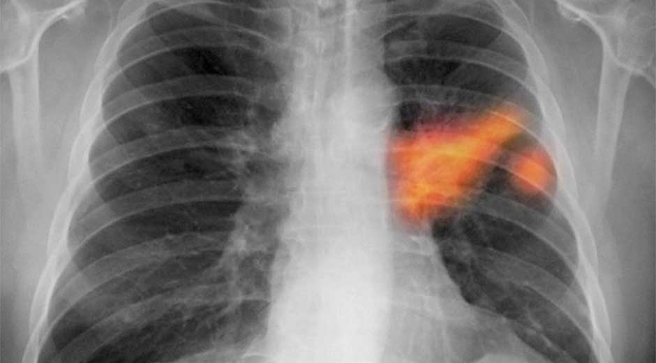 Cáncer de pulmón, el más mortal de todos