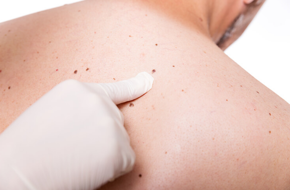 Experto afirma que el cáncer de piel es frecuente en mayores de 50 años