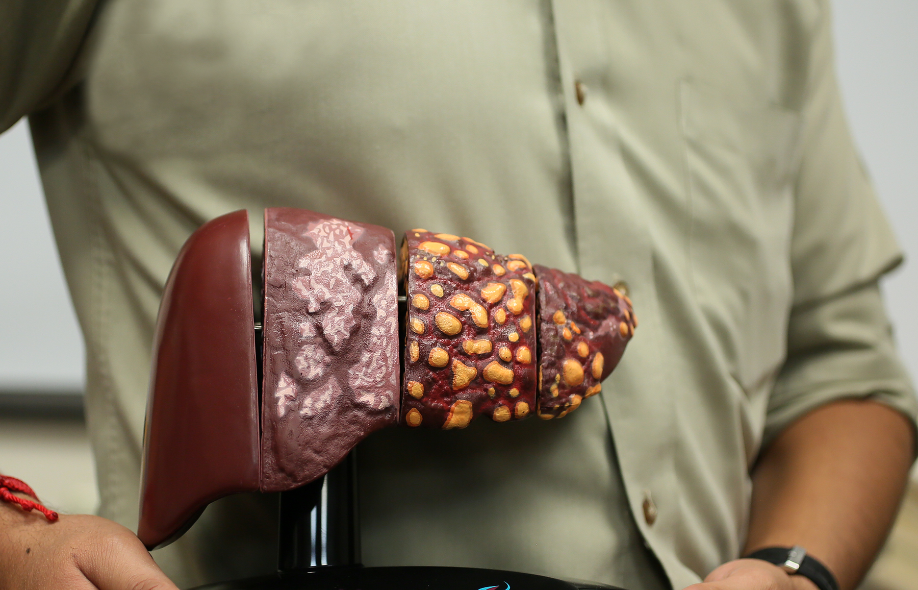 Hígado graso podría diagnosticarse con prueba de sangre