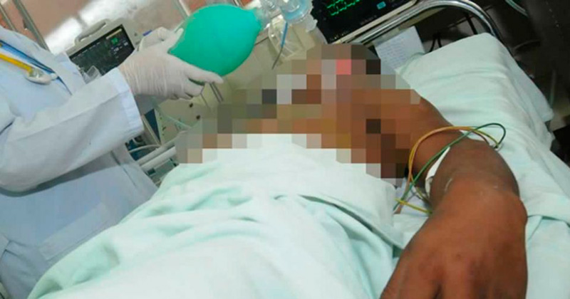 140 nuevos casos de lepra en México se registraron en 2017