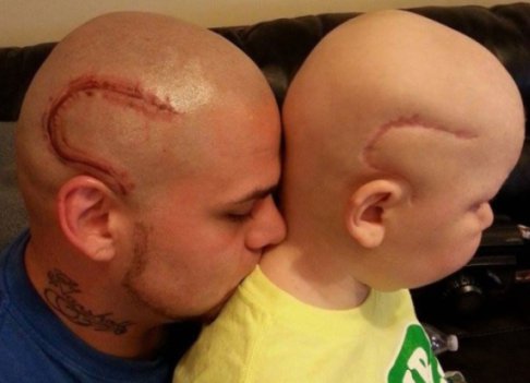 Muere niño cuyo padre se tatuó una cicatriz como la suya en la cabeza