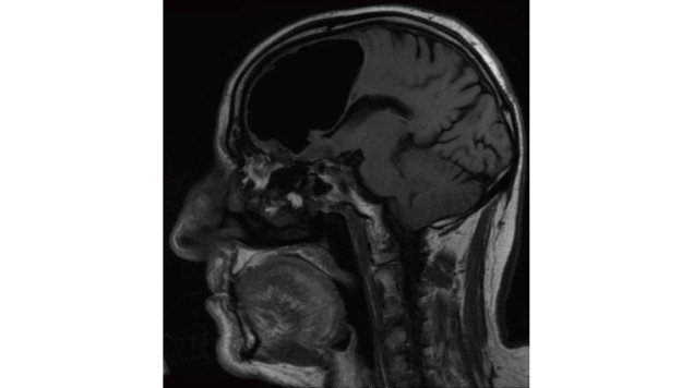 Fue a revisión y el médico halló un hueco de aire donde debería estar su cerebro