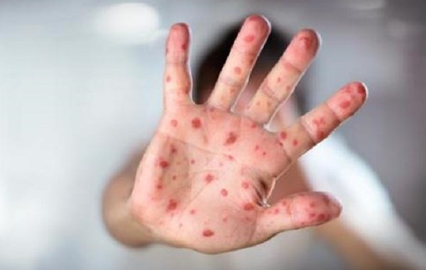 Confirman tres casos de sarampión en México