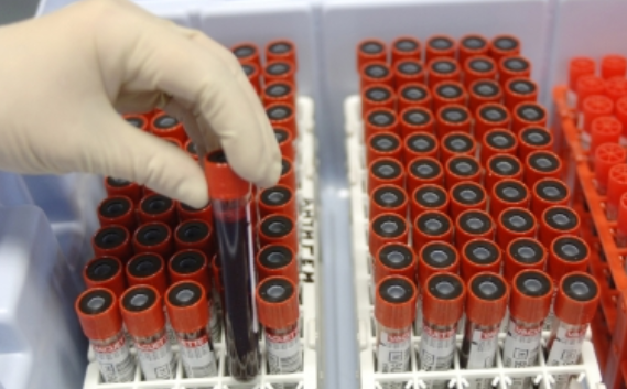 Podría análisis de sangre detectar cáncer en etapa temprana