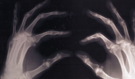 Baja ingesta de calcio aumenta riesgo de osteoporosis y fracturas