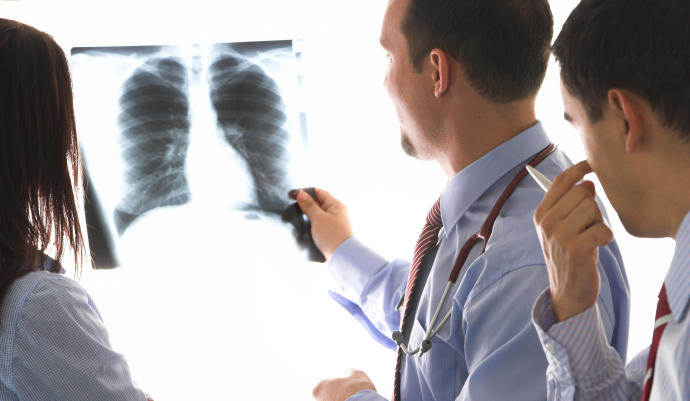 80 por ciento de casos de cáncer del pulmón se diagnostican en etapa avanzada