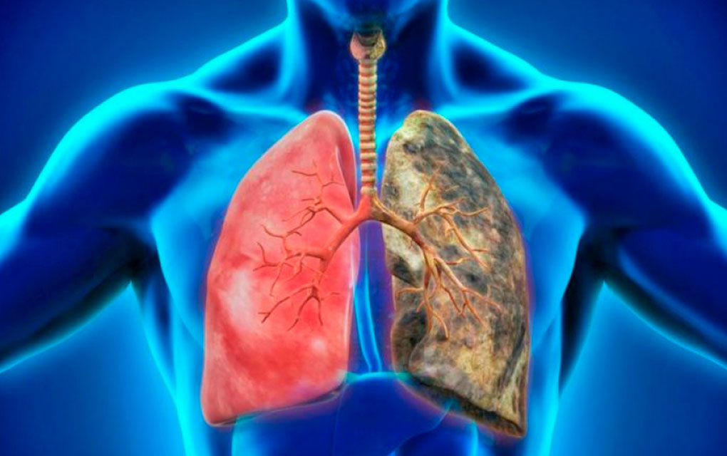 Población desconoce enfermedad pulmonar obstructiva crónica