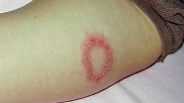 Reportan múltiples casos de lepra en Guanajuato