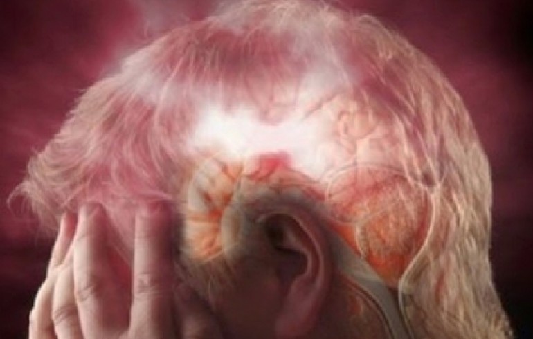 Epilepsia, patología que se debe a una actividad anormal del cerebro