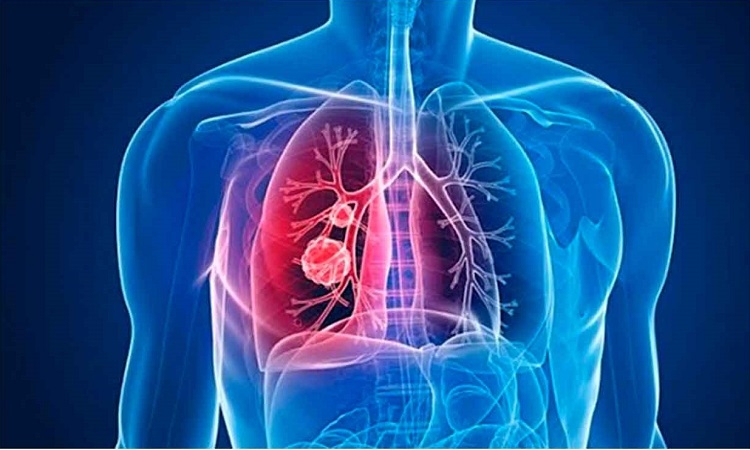 Diagnóstico y tratamiento oportuno, retos en la hipertensión pulmonar