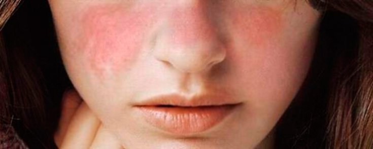 Lupus eritematoso, enfermedad renal que afecta mayormente a mujeres