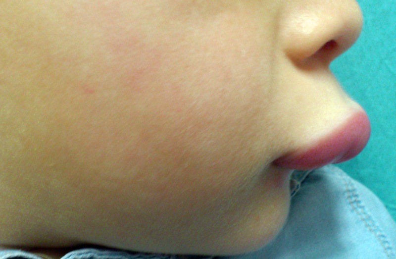 Diagnóstico temprano de angioedema mejora calidad de vida en pacientes