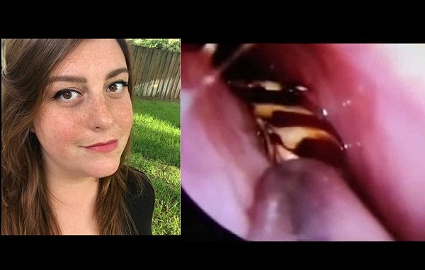 Mujer vivió nueve días con cucaracha en el oído