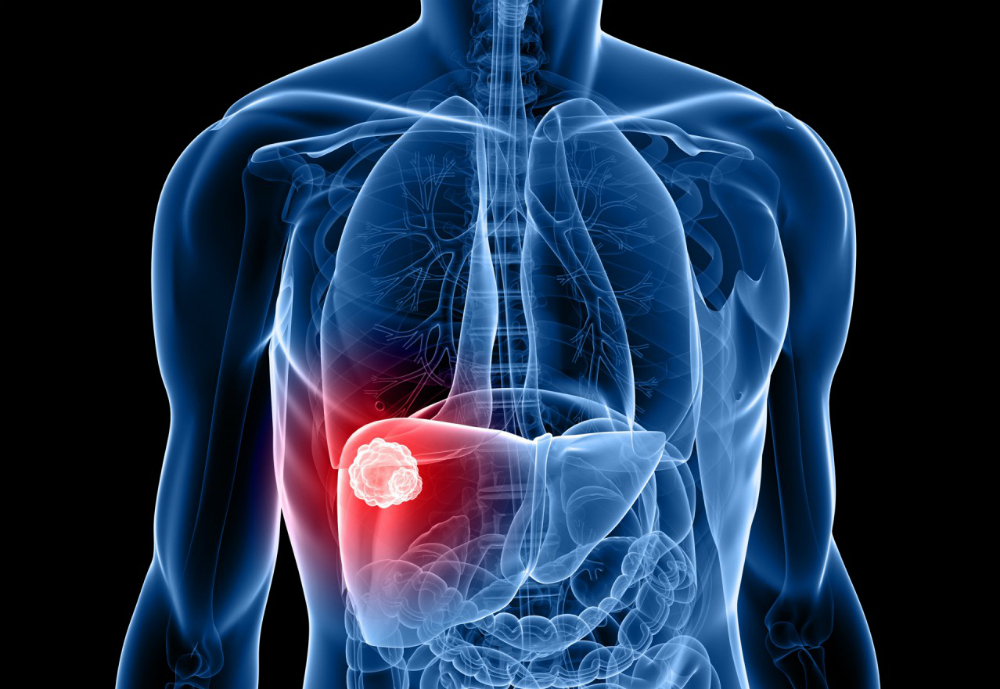 Obesidad y hepatitis aumentan incidencia de cáncer de hígado
