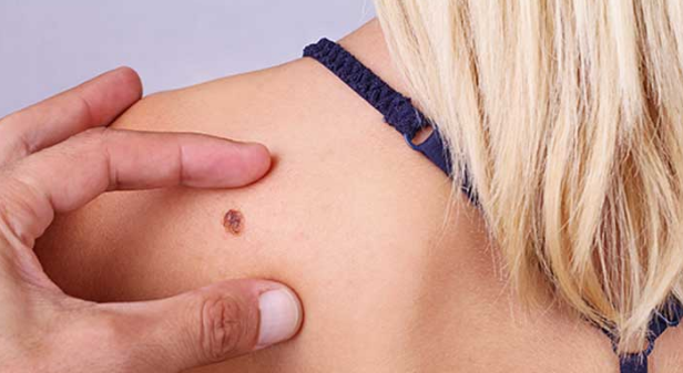 Experta afirma que el melanoma es el cáncer de piel más agresivo