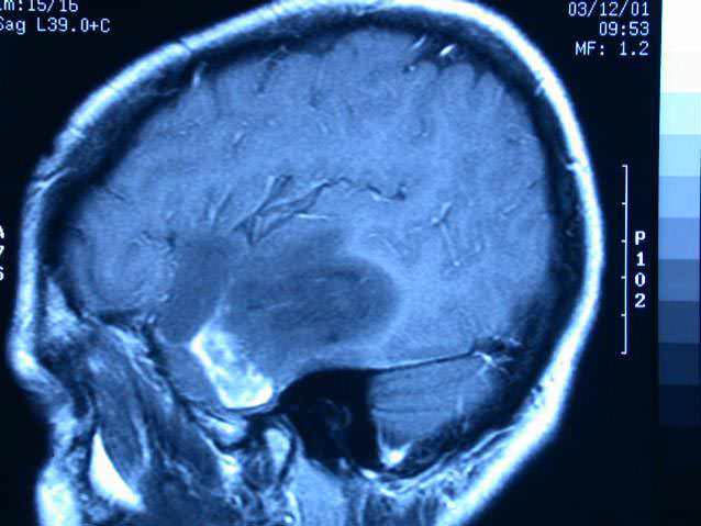 Componentes de fármacos podrían ayudar a combatir tumorcerebral