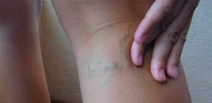 Presenta várices 80 por ciento de la población mexicana