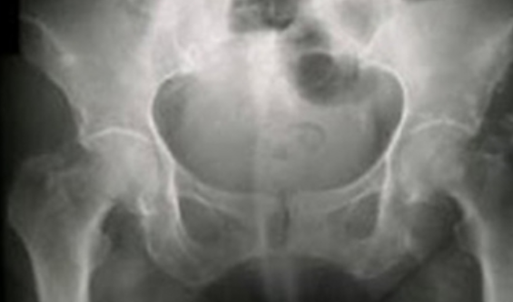 Hernia de disco no es la única causa del dolor de cadera, especialista