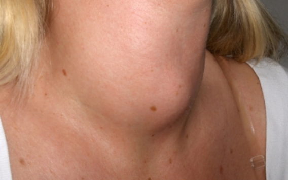 Cáncer de tiroides afecta más a mujeres jóvenes, señala especialista