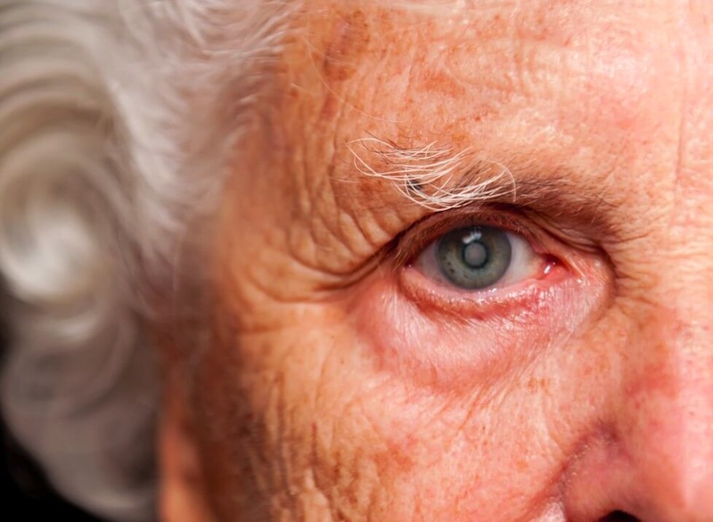 Cataratas, causa más común de pérdida de la visión en personas mayores