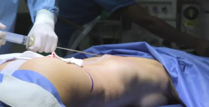 Muere mujer por liposucción realizada en Piedras Negras