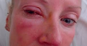 Mujer pierde la vista por bañarse con los lentes de contacto puestos