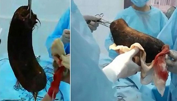 Remueven bola de pelo del estómago de niña de 12 años